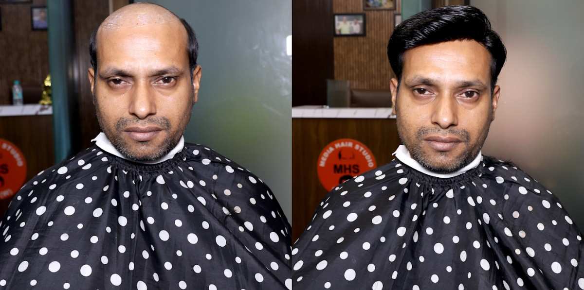 Hair Loss Solution