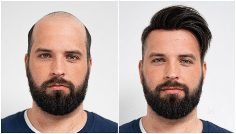 Another Before After Hair Transplant