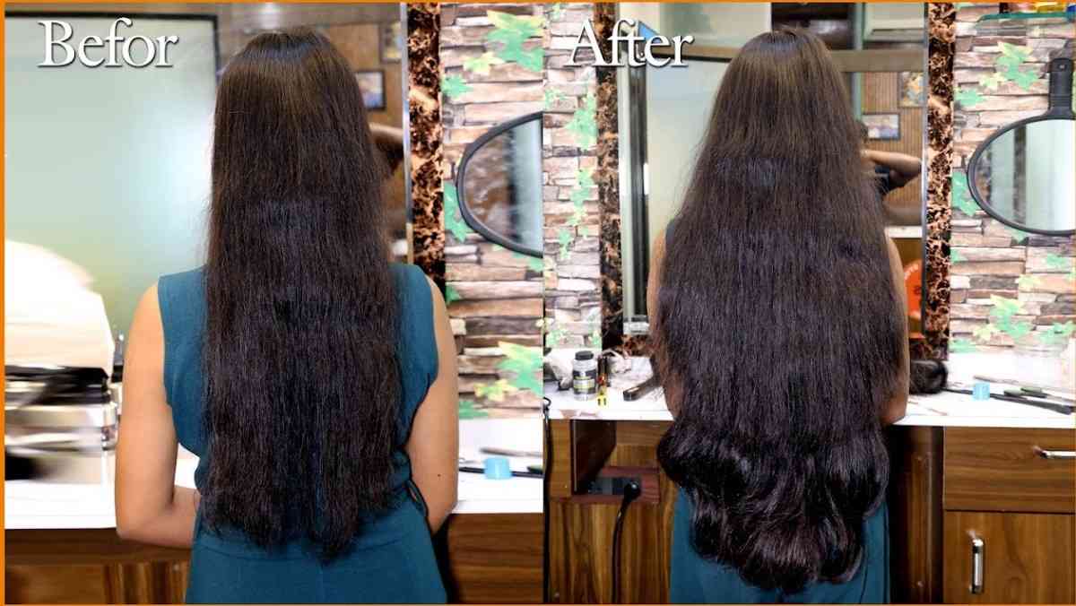 Before After Hair Transplant